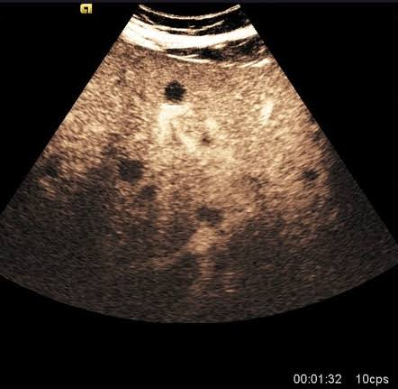 <p>uniformly hypo lesions</p><p>wheel within wheel </p>