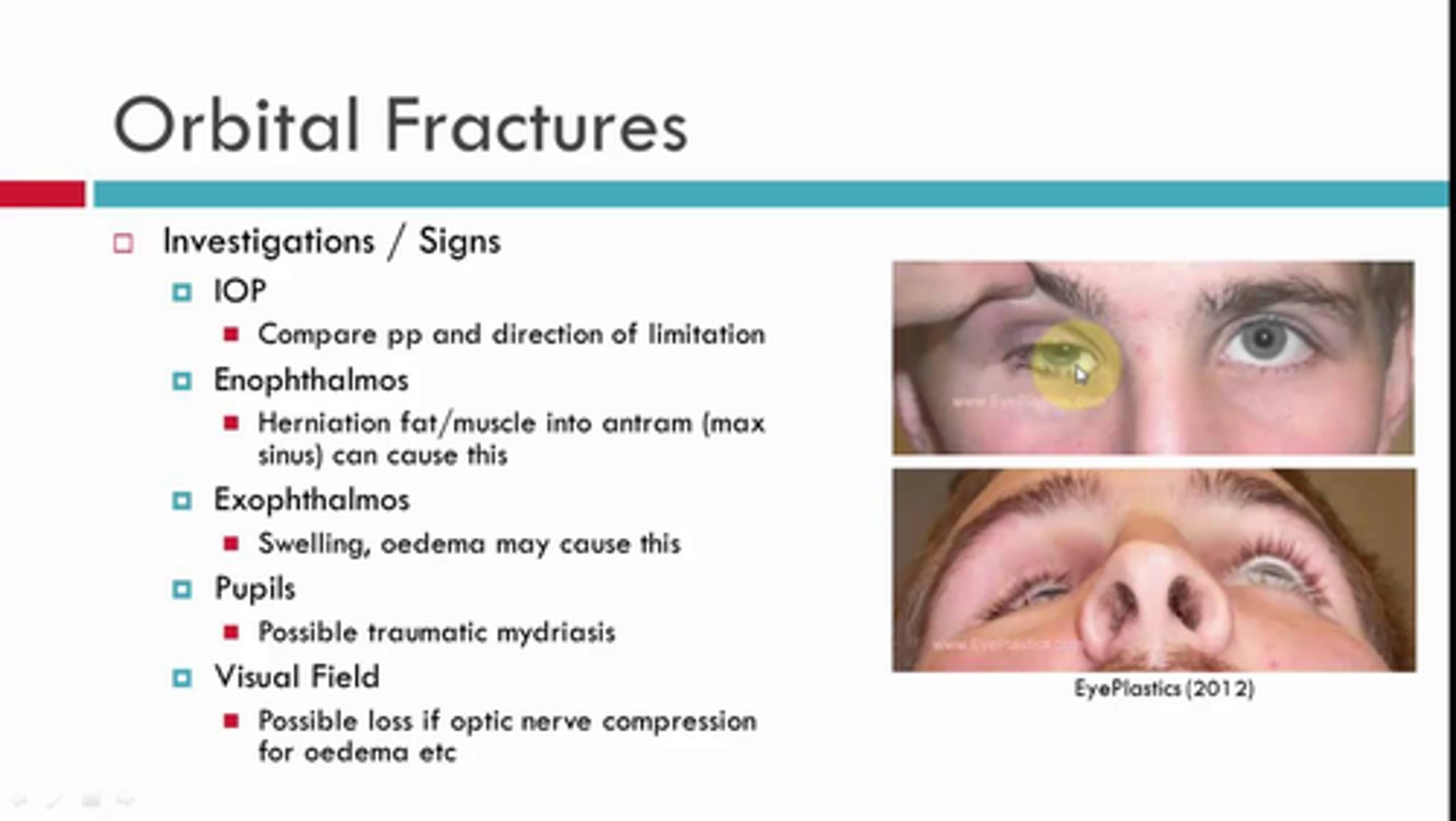 <p>D) orbital floor fracture.</p><p>EXPLANATION</p><p>Blow-out fracture is a traumatic deformity of the orbital floor.</p>