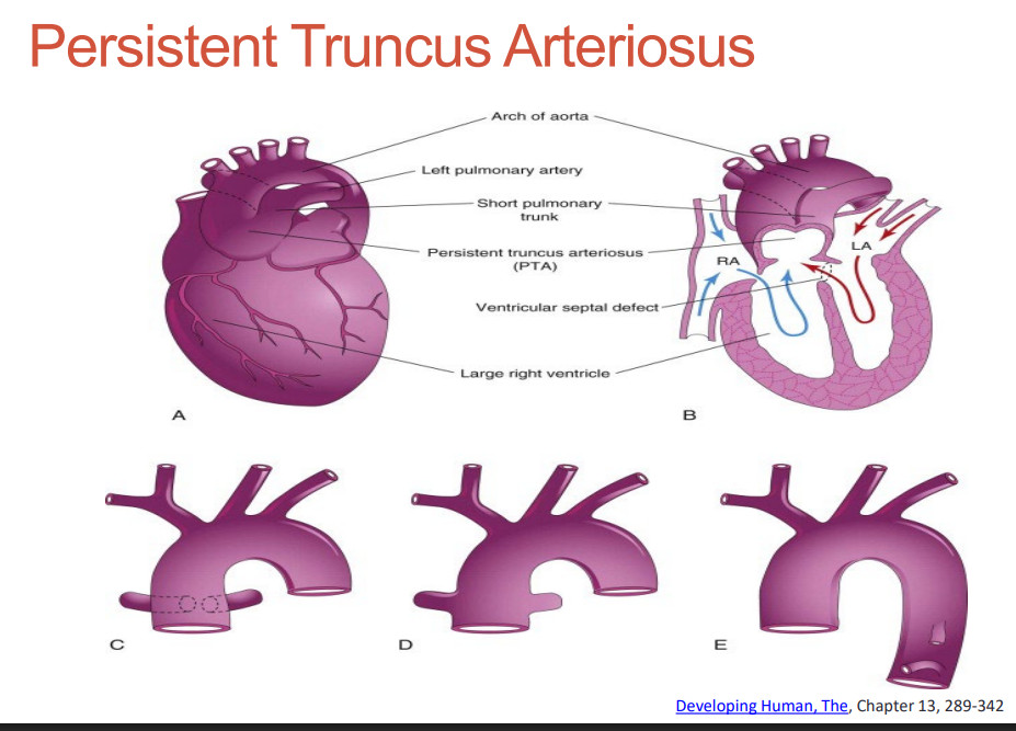 <p>• A Malalignment VSD is almost always present</p>