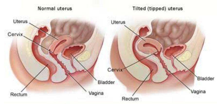 <ul><li><p>Usually <strong>anteverted</strong> (tilted forward towards the bladder).</p></li><li><p>About 25% of women have a <strong>retroverted uterus</strong> (tilted backwards).</p></li></ul><p></p>