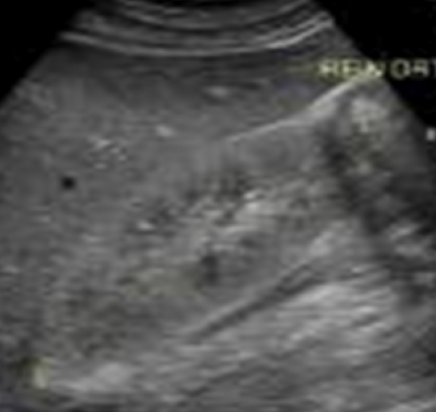 <p>echogenic, enlarged kidneys </p>