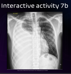 <p>Given the patient symptoms and radiographic findings, what is the best next course of action? </p><p>a. Emergency referral to the hospital </p><p>b. Referral to primary care physician </p><p>c. Trial of chiropractic care </p><p>d. No follow-up necessary</p>