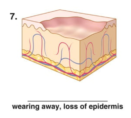 <p>wearing away, loss of epidermis</p>