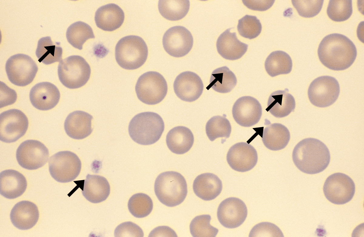 <p>RBC inclusions are present when diseased. What kind of RBC is this? Describe it.</p>