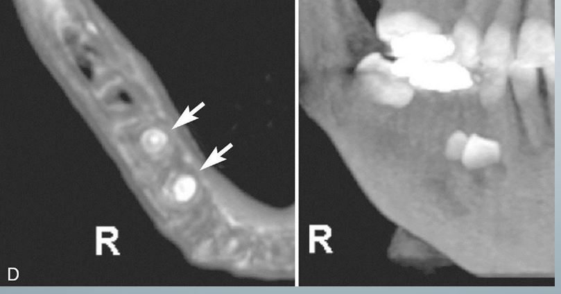 <p>-can investigate the location of the relationship with adjacent structures such as other teeth, the inferior alveolar canal, the maxillary sinus, etc. </p><p>-2D cannot provide the information</p>