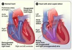 <p>3nd most common, 10-15% of CHD; 2:1 female to male</p>