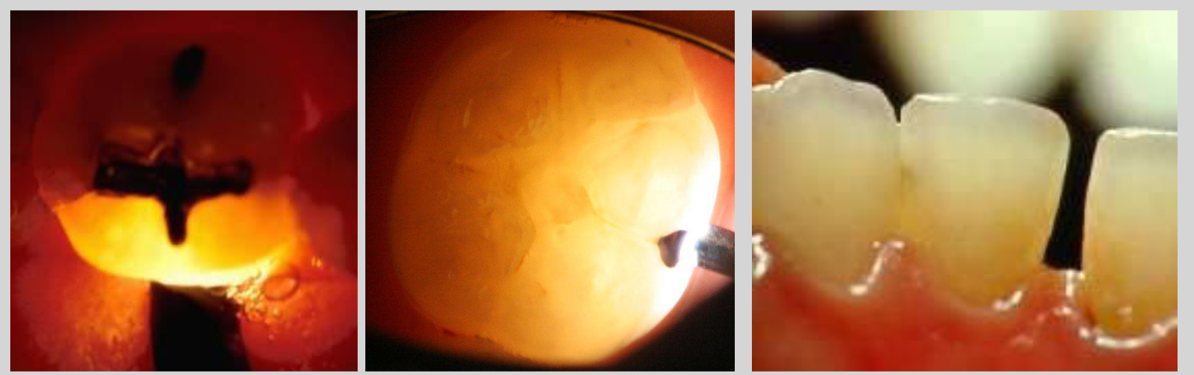 <p>Trans-illumination of a cracked tooth and</p><p>proximal caries</p>
