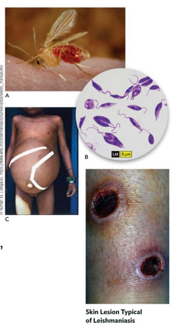 <p>Leishmaniasis</p>