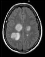 <p>Acute, inflammatory demyelinating disorder that may affect infants and children after a febrile illness. Children may present with a variety of symptoms and signs including monocular vision loss (e.g., acute optic neuritis), hemiparesis, ataxia, seizures, headache, weakness, or dysphagia.</p>