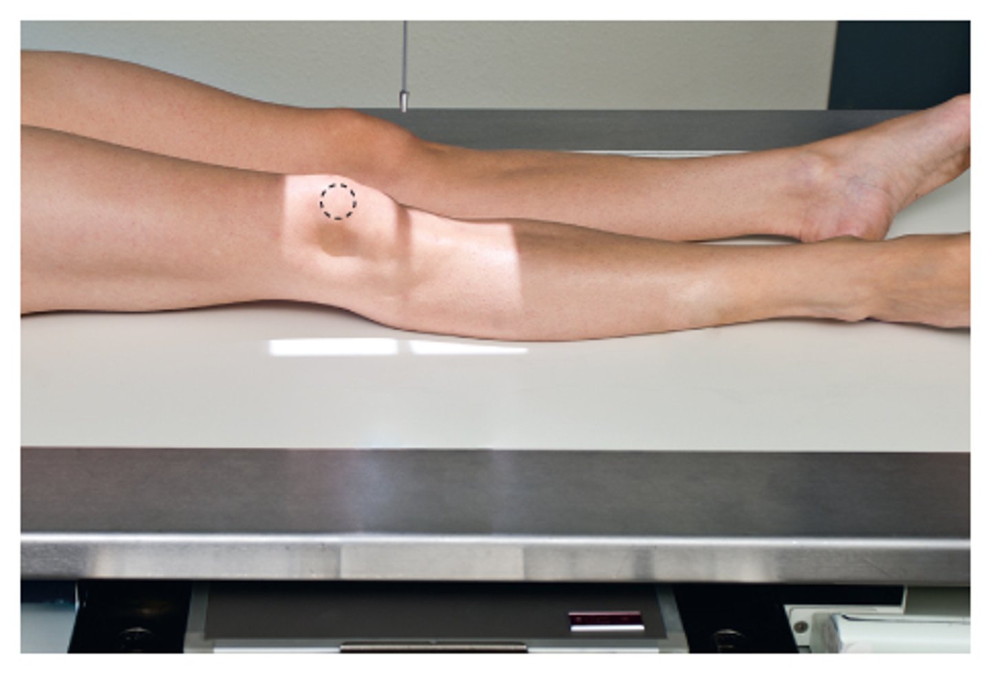 <p>S - on lap</p><p>T - 5 mAs @ 60 kVp</p><p>A - none</p><p>M - correct marker on cassette</p><p>P - PT supine w/ knee rotated 45 externally, CR 1/2" below patella</p><p>S - 40"</p><p>B - suspension</p><p>C -10 x 12 lengthwise</p>