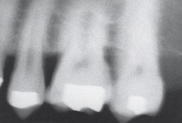 <p>Blurred Image </p><p><strong>What it looks like:</strong><br>The image appears <strong>fuzzy or unclear</strong>.</p><p> </p><p><strong>Cause:</strong><br>Patient <strong>movement</strong> during exposure.</p>