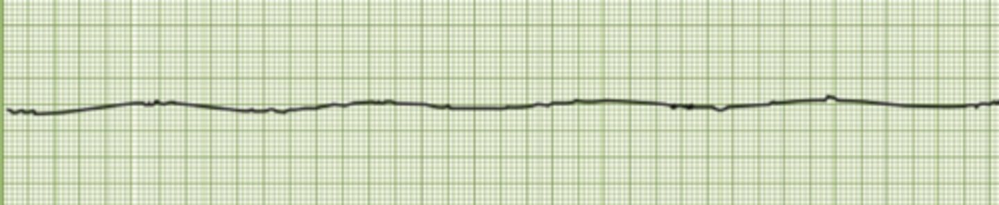 <p>No contraction, mostly strait line</p>
