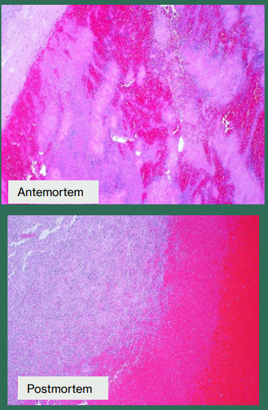 <ul><li><p><span style="background-color: transparent;"><strong>Gross:</strong> A solid mass inside the artery. A "Saddle Embolus" sits right where the main artery splits.</span></p></li><li><p><span style="background-color: transparent;"><strong>Histology:</strong> <strong>Lines of Zahn</strong>. These are alternating pale layers (platelets/fibrin) and dark layers (red blood cells) that prove the clot formed <em>while the patient was alive</em>. (</span>diagnostic of antemortem clot)</p></li></ul><p></p>