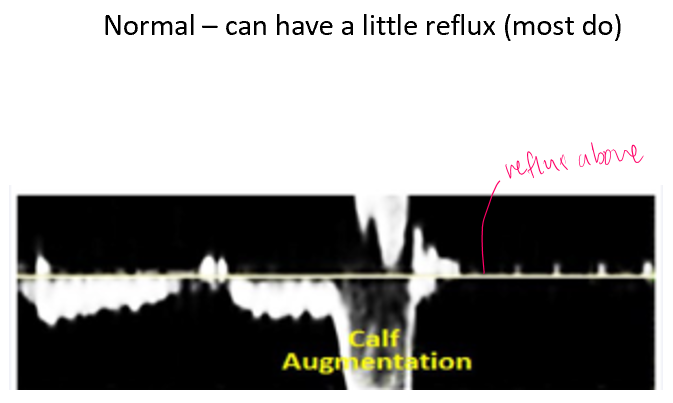 <p>normal distal augment</p>