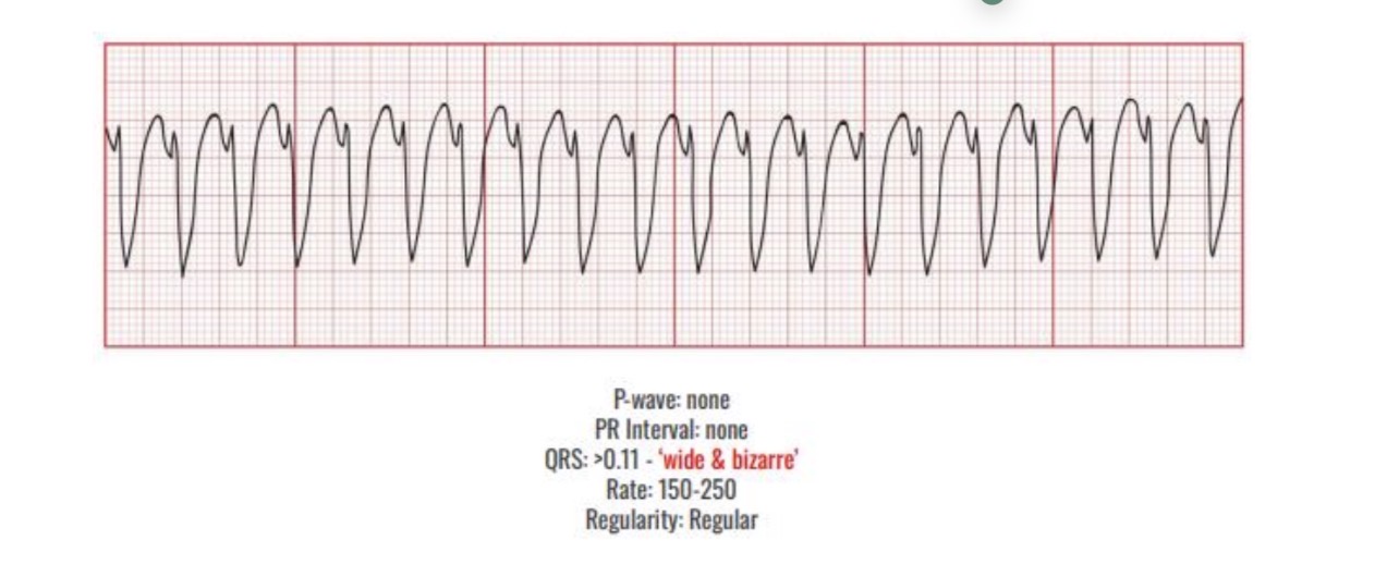 <p>Causes</p><p>MI</p><p><span><span>-Ischemia</span></span></p><p><span><span>-Digoxin Toxicity</span></span></p><p><span><span>-Hypoxia</span></span></p><p><span><span>-Acidosis</span></span></p><p><span><span>-Hypokalemia</span></span></p><p><span><span>-Hypotension</span></span></p><p></p><p><span><span>Interventions </span></span></p><p><span><span>Fix the cause</span></span></p><p><span><span>YES pulse:</span></span></p><p><span><span>-Cardioversion</span></span></p><p><span><span>NO pulse:</span></span></p><p><span><span>-CPR</span></span></p><p><span><span>-Defibrillate</span></span></p><p><span><span>-EpinephrineRMIT Classification:</span></span></p>