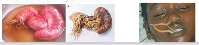 <p>Very common in developing countries: 1 billion cases</p><p>.</p><p>Pathology</p><p>- 85% asymptomatic</p><p>- worms cause intestinal obstruction (basially eggs hatch in body), particularly in children - Migrating larvae travel to lungs - inflammation - Loefflers syndrome, can travel to other organs</p><p>- Ascaris metabolites can cause sensitizing phenomena, such as urticaria, and asthma. (because it can get stuck while on its way to the lungs)</p><p>- Can move around the body inadvertently blocking narrow organs like the bile duct. Can even appear down the nose</p><p>- Malnutrition especially in children</p>