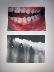 <p>A flat bluish-gray lesion of the oral mucosa that results from the introduction of amalgam particles into the tissues.</p><p>Can occur during placement/removal of amalgam. Or during EXT. most commonly on gingiva or alveolar ridge</p>