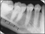 <p>mylohyoid ridge</p>