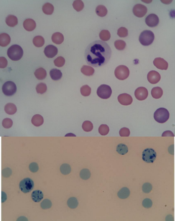 <p>» May take 3-5 days to be seen in peripheral blood</p><p></p><p>» Polychromatophils see on standard stain</p><p>• Purple staining</p><p>• Usually larger in size</p><p></p><p>» New Methylene Blue stain</p><p>• Ribosomes and Polyribosomes stained by supravital stain</p><p></p><p>» Younger erythrocytes</p><p>• Increased MCV (Mean Corpuscular Volume) stands for mean corpuscular volume, which measures the average size of your red blood cells)- macrocytic</p><p>• Decreased MCHC (mean corpuscular hemoglobin concentration, which is a measurement of the average concentration of hemoglobin inside your red blood cells)- hypochromic</p><p>• Increased RDW (red blood cell distribution width)- anisocytosis (cell size variation)</p>