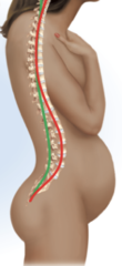 <p>Hyperlordosis (swayback)</p>