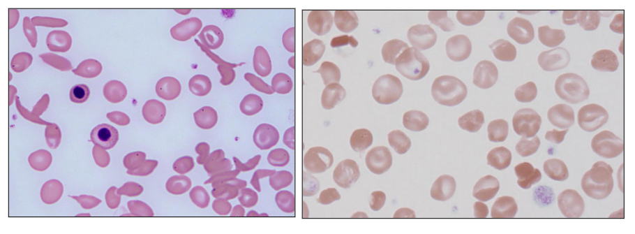 <p>- Point mutation resulting in amino acid substitution</p><p>- Structurally abnormal Hb (haemoglobin)</p><p>- Clinical features dictated by properties of the abnormal Hb from the amino acid substitution</p><p>- E.g sickle haemoglobin (HbS); target cells: HbE, HbC</p><p>- on the left, the red cells are shaped like a sickle</p>