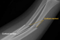 <p>what is a greenstick fracture and why is it significant</p><p>Actual green stick mostly bends some cracks</p>