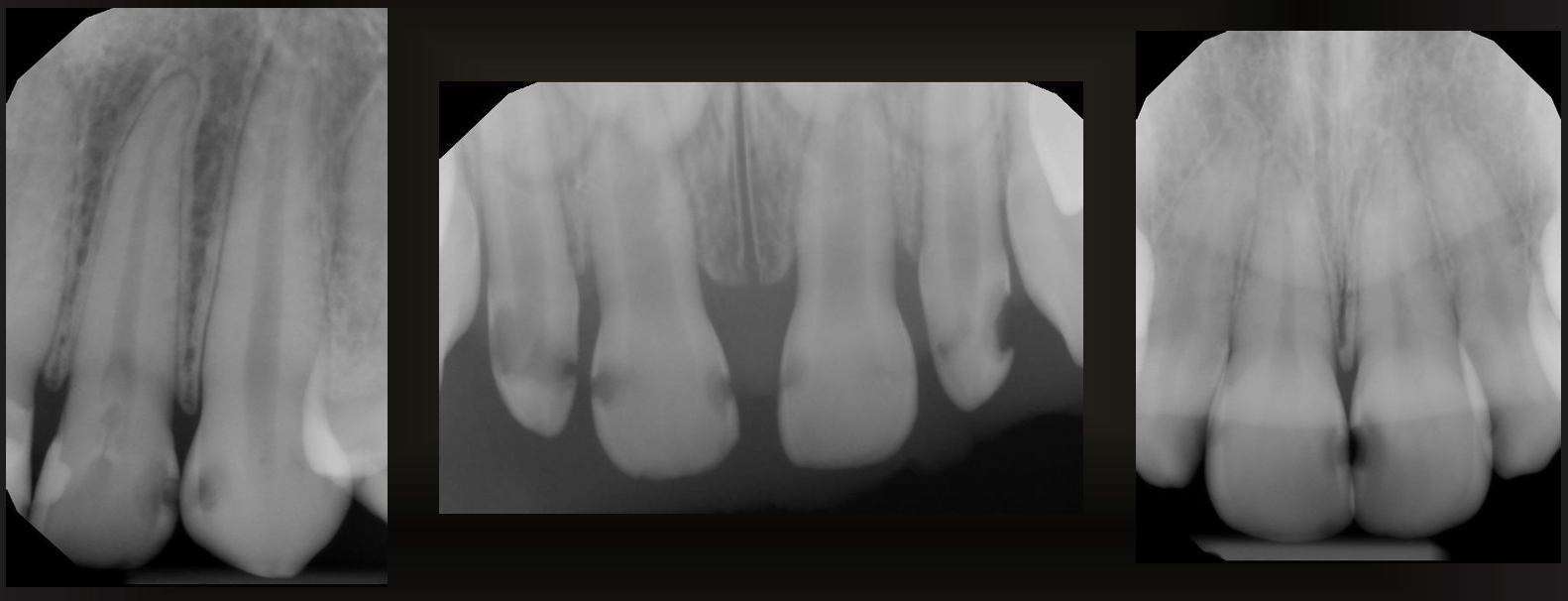 <p>are these caries or restorations with radiolucent material?</p>