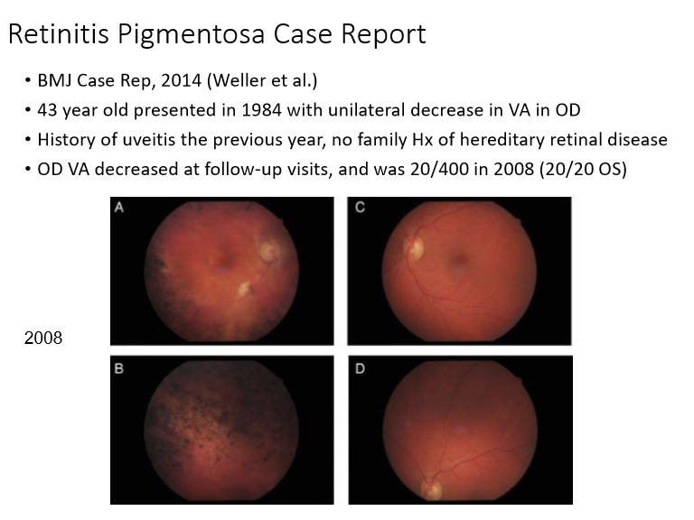 <p>Yes, very rarely can affect only 1 eye instead of bilaterally. </p>