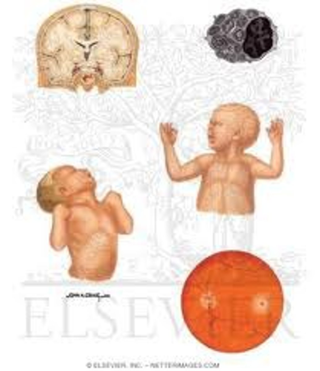 <p>- It is conditioned as a degenerative disease of the brain and nerve cells, resulting in death before age 5</p><p>- Those who are at risk are primarily found in Eastern European Jewish families</p><p>- However, it cant be treated because there is no treatment.</p>