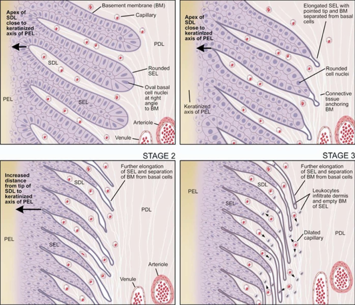 <p>occurs when the lamina tears away from the hoof wall</p><ul><li><p>secondary epidermal lamellae elongate to a point (normally rounded)</p></li><li><p>pointed tip and basement membrane separate from basal cells of the primary dermal lamellae</p></li><li><p>leukocytes infiltrate dermis and empty basement membrane of the secondary epidermal lamellae</p></li></ul><p></p>
