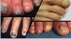 <p>What is this disease?</p>