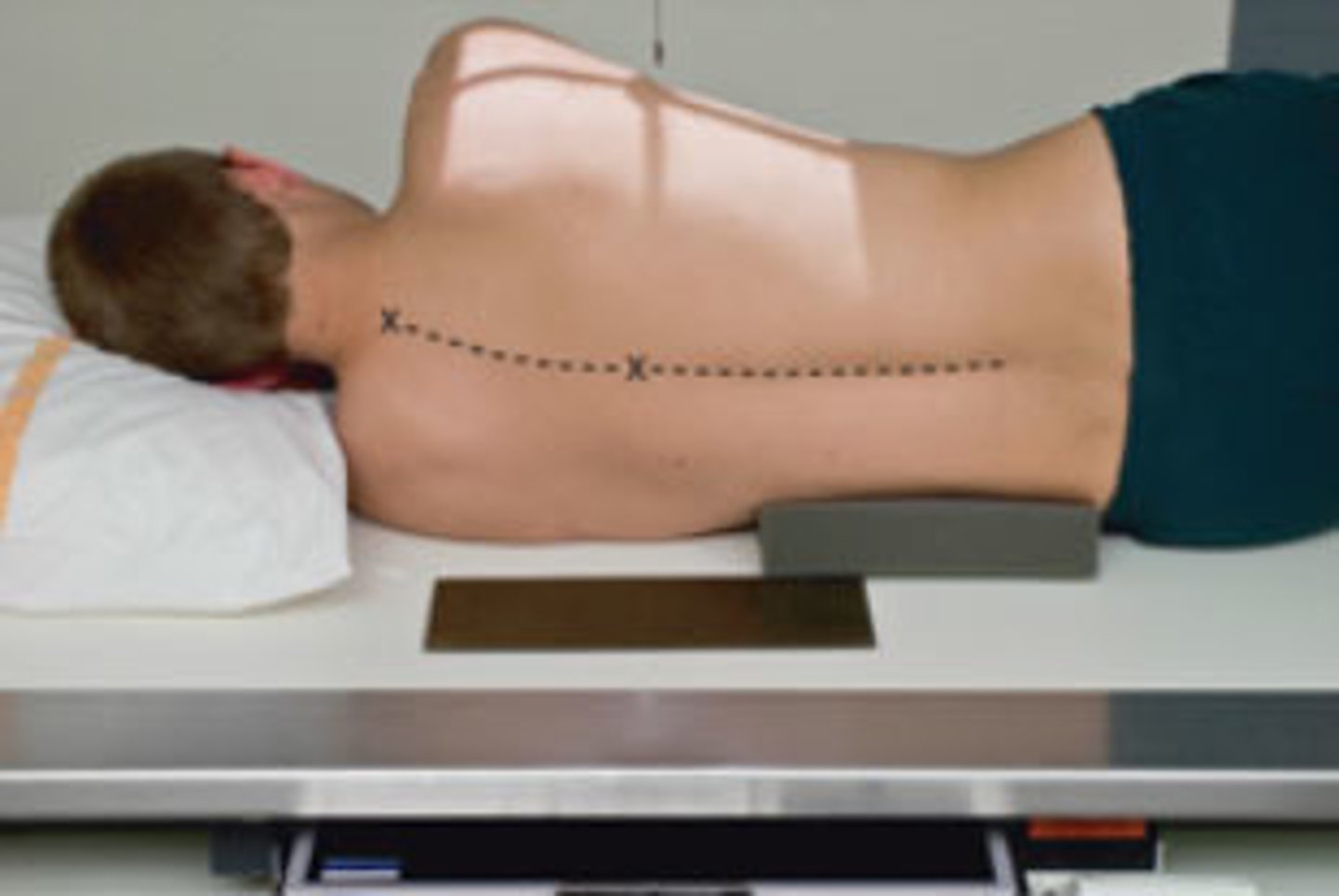 <p>S - over hip</p><p>T - 40 mAs @ 80 kVp</p><p>A - none</p><p>M - L marker in front of PT</p><p>P - PT on L side w/ sponge & lead blocker, CR T7 & back 1" from midcoronal plane</p><p>S - 40"</p><p>B - orthostatic</p><p>C - 14 x 17 lengthwise, can collimate in side to side</p>