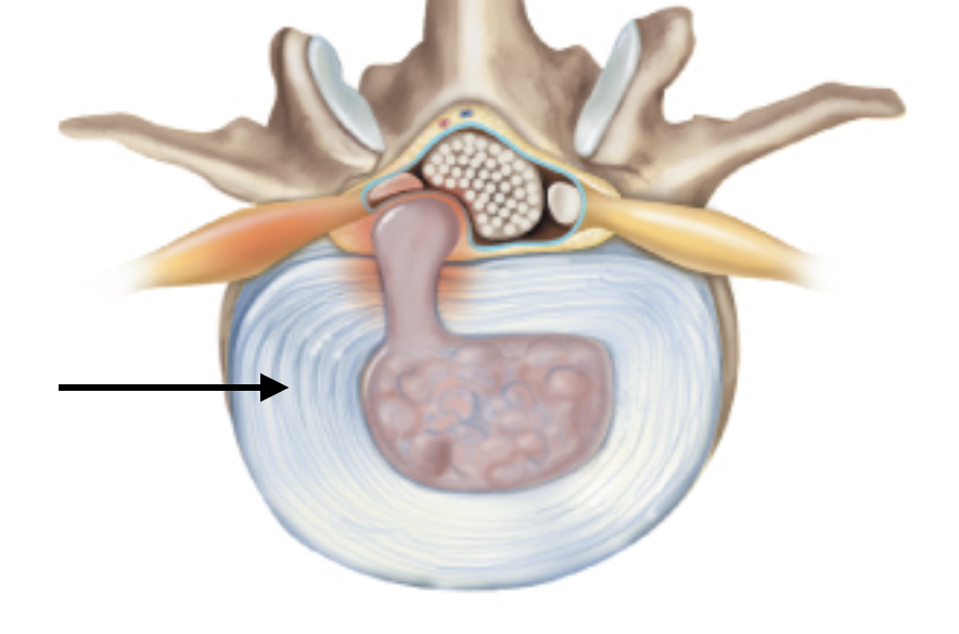 <p>Identify the anatomical feature of an intervertebral disc and its surrounding structures.</p>