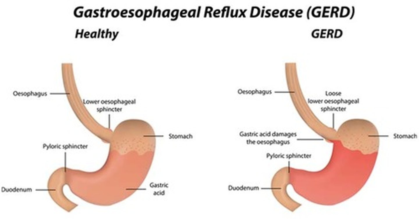 <p>gastroesophageal reflux disease (GERD)</p>