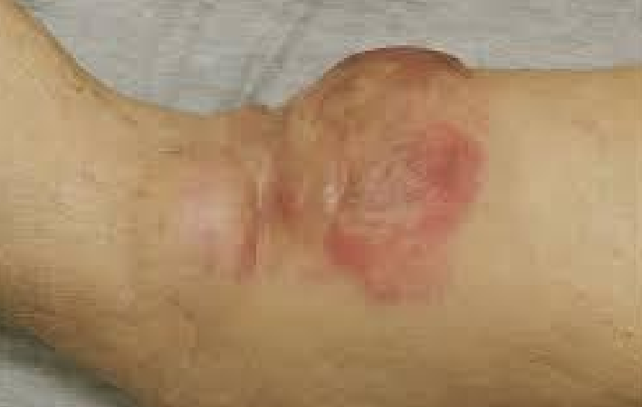 <p>Describe this lesion</p>
