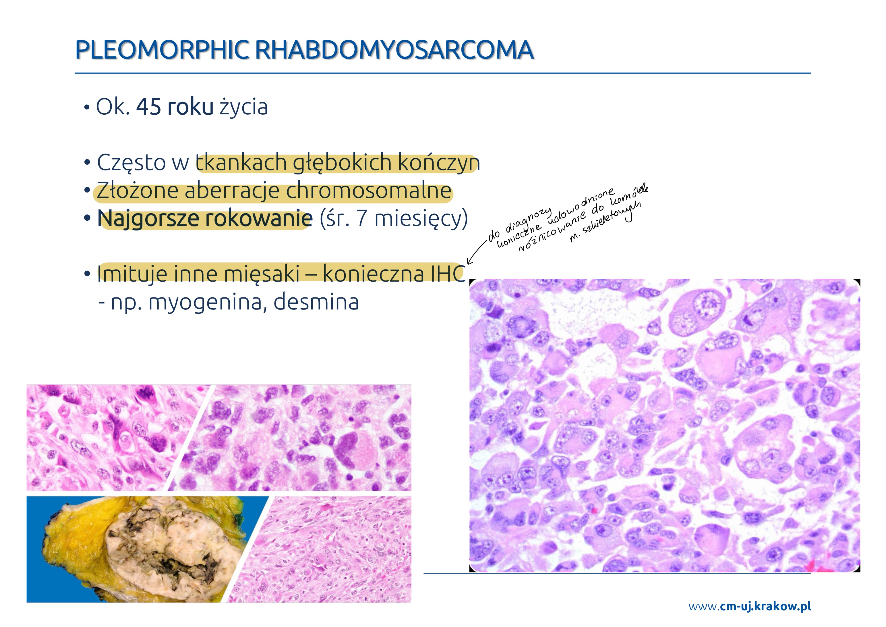 <p>MORFOLOGIA</p><ul><li><p>liczne komórki olbrzymie, dziwaczne i wielojądrzaste o eozynofilnej cytoplazmie, imitujących komórki w innych mięsakach pleomorficznych</p></li><li><p>rozpoznanie jeśli udowodnione różnicowanie do komórek mięsni szkieletowych (konieczna IHC, np. na myogeninę)</p></li></ul><p></p>