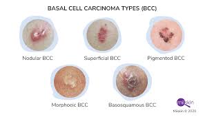 <p>The least malignant and most common skin cancer; presents as a small red nodule or sore that does not heal.</p>