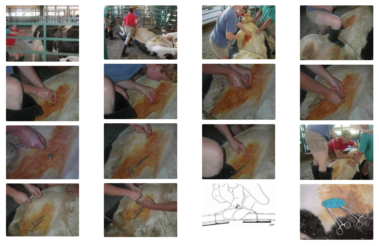 <ol><li><p>Cast cow onto right side using Reuff’s method → Roll onto back (0.1mg/kg xylazine IV)</p></li><li><p>Tie front and rear legs if required</p></li><li><p>Insert 10 - 15cm behind xyphoid and 5 - 8cm to the right of midline</p></li><li><p>Use pressure to push abomasum into right position</p></li><li><p>Push trocar through wall avoiding milk vein and other vital structures</p></li><li><p>Draw off fluid and check pH is 2 - 4</p></li><li><p>Remove nylon handle and introduce toggle</p></li><li><p>Push toggle clear of trocar/cannula with the push rod</p></li><li><p>Pull to ensure toggle is clear of trocar (not too tightly)</p></li><li><p>Remove trocar/cannula and clamp nylon with needle holder</p></li><li><p>Place 2nd toggle 5 - 7cm anterior of 1st toggle</p></li><li><p>Before removing 2nd trocar, remove as much free gas as possible from abomasum</p></li><li><p>Place surgeon’s knot tied with hands (clamps still remain on)</p></li><li><p>Leave a hand width’s distance between knot and body wall</p></li><li><p>Consider placing a toggle button to distribute pressure (MANY knots to secure in place)</p></li></ol><p></p>