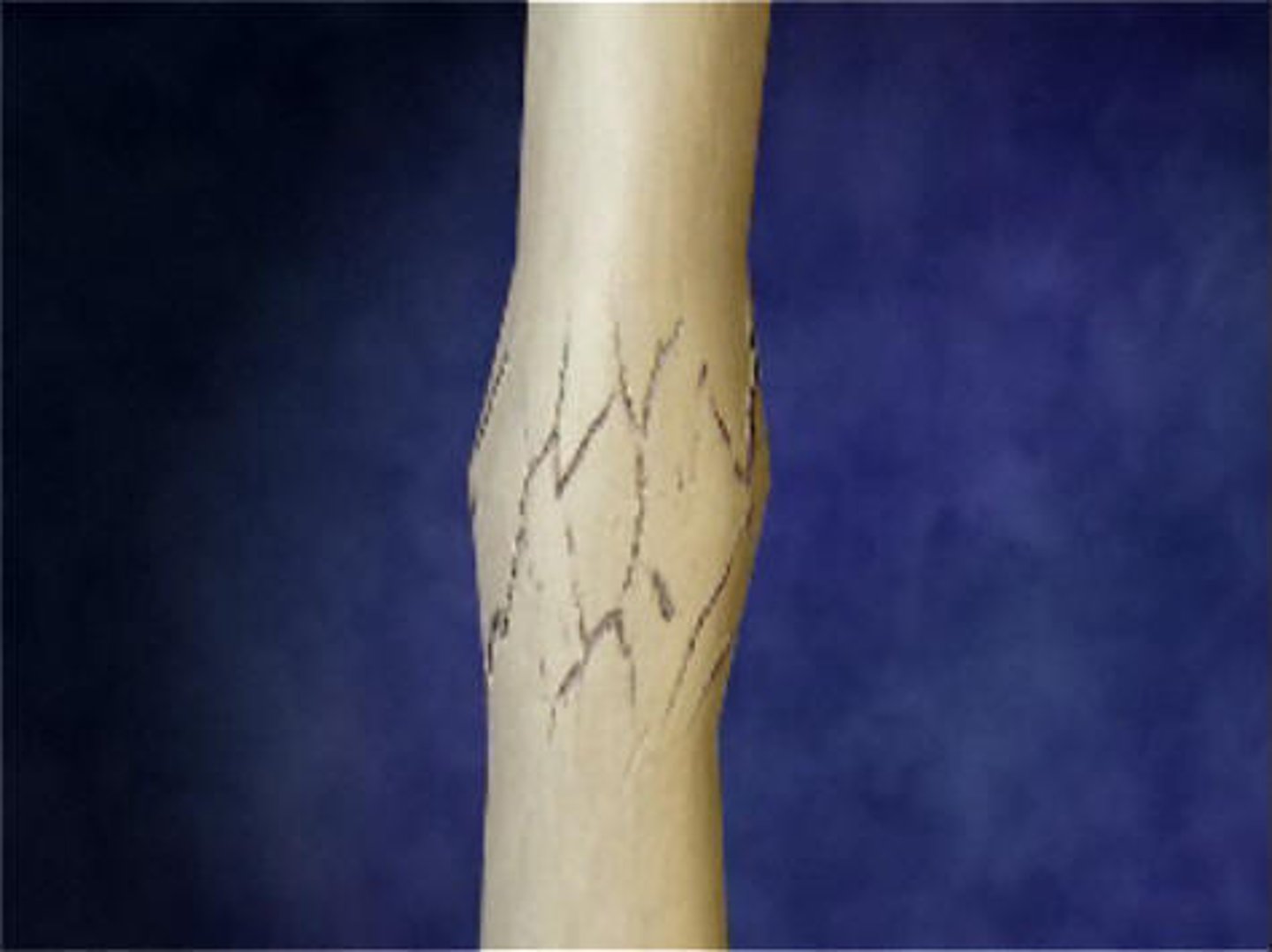 <p>Bone fragments are driven forcefully together</p>