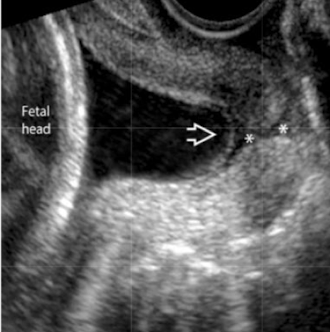 <p>is this normal or cervical incompetence?</p>