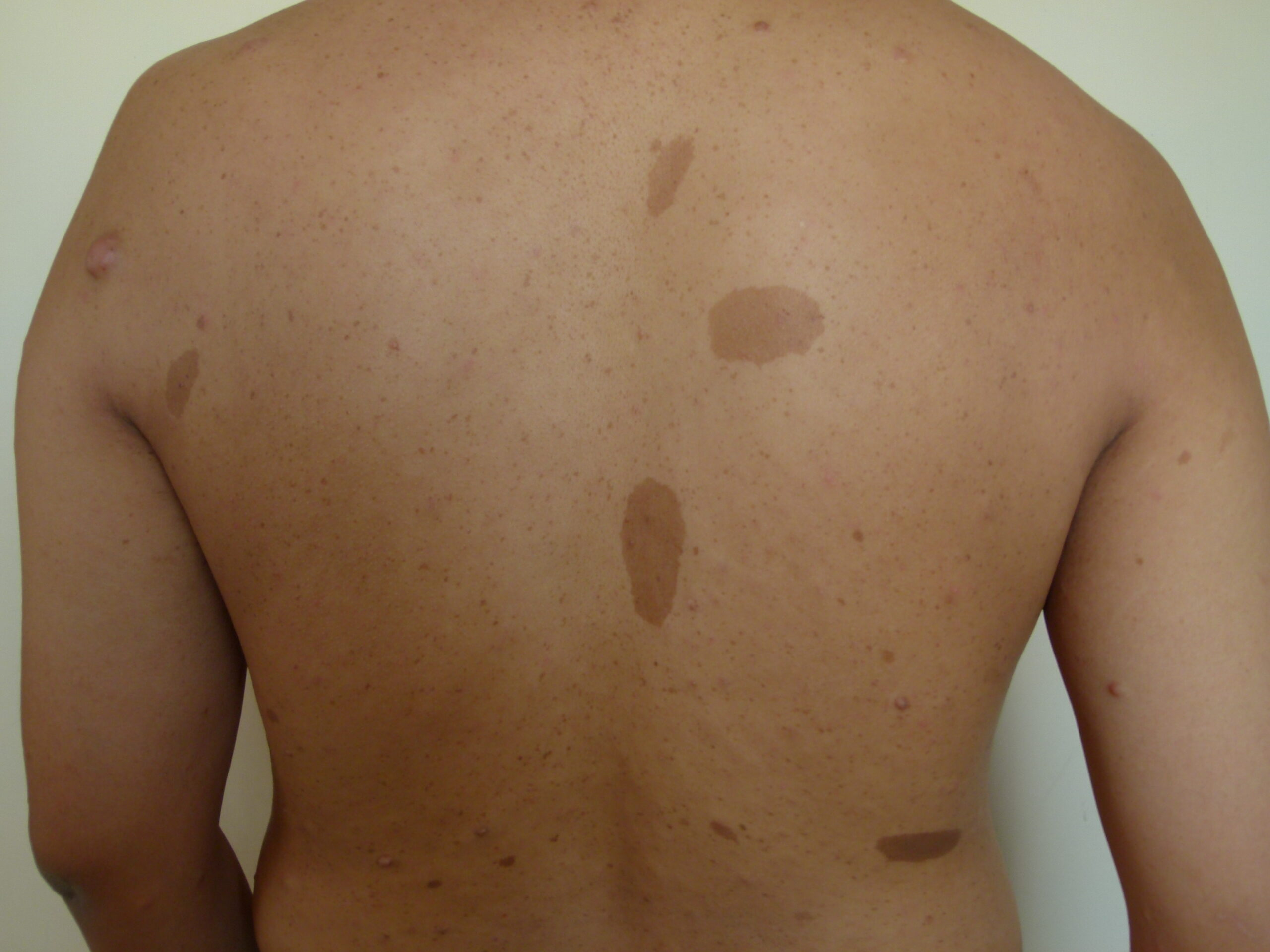 <p>round or oval patch of light brown pigmentation usually present at birth </p><p></p>