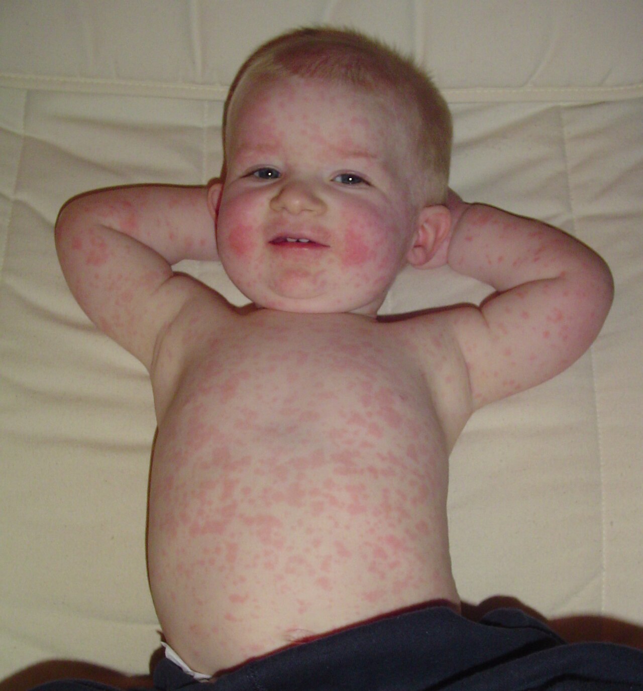 <p>how long can the rash of <strong>fifth disease</strong> last?</p>