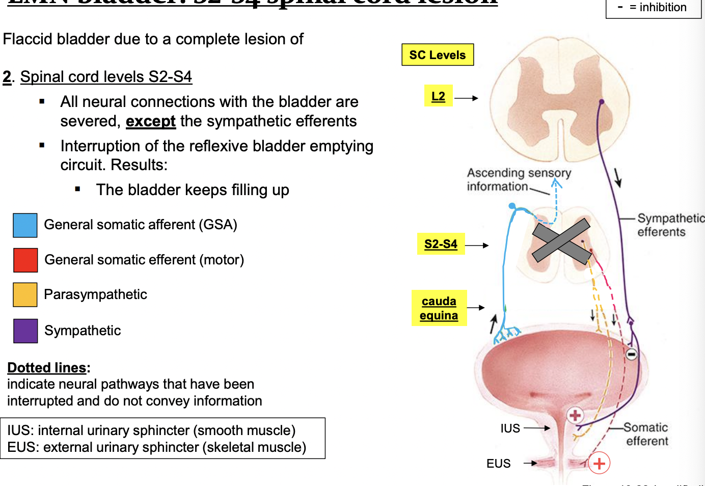 <p>flaccid bladder due to a complete lesion of: </p><ul><li><p>spinal cord levels S2-S4 </p><ul><li><p>all neural connections with the bladder are severed, except the sympathetic efferents </p></li><li><p>interruption of the reflexive bladder emptying circuit. Results: </p><ul><li><p>the bladder keeps filling up </p></li></ul></li></ul></li></ul><p></p>