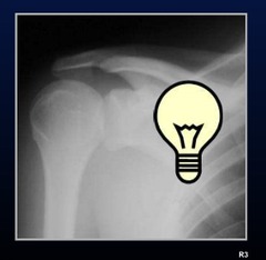 <p>XRay sign of posterior dislocation</p>