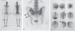 <p>Bone Scan</p>