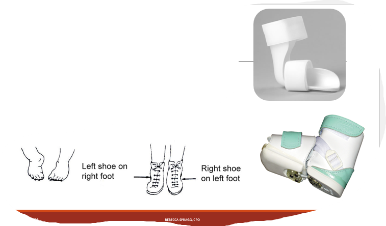 <p>Wheaton AFO </p><p>Reverse last shoes - or shoes on the opposite feet </p><p>Bebax shoes </p><p>SMOs for older kids </p>