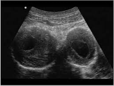 <p>iliac artery aneurysms</p>