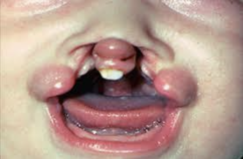 <p>The patient in the photo also has a cleft palate. What is the appropriate classification for this patient?</p><p>A. Class I </p><p>B. Class II </p><p>C. Class III </p><p>D. Class IV</p>