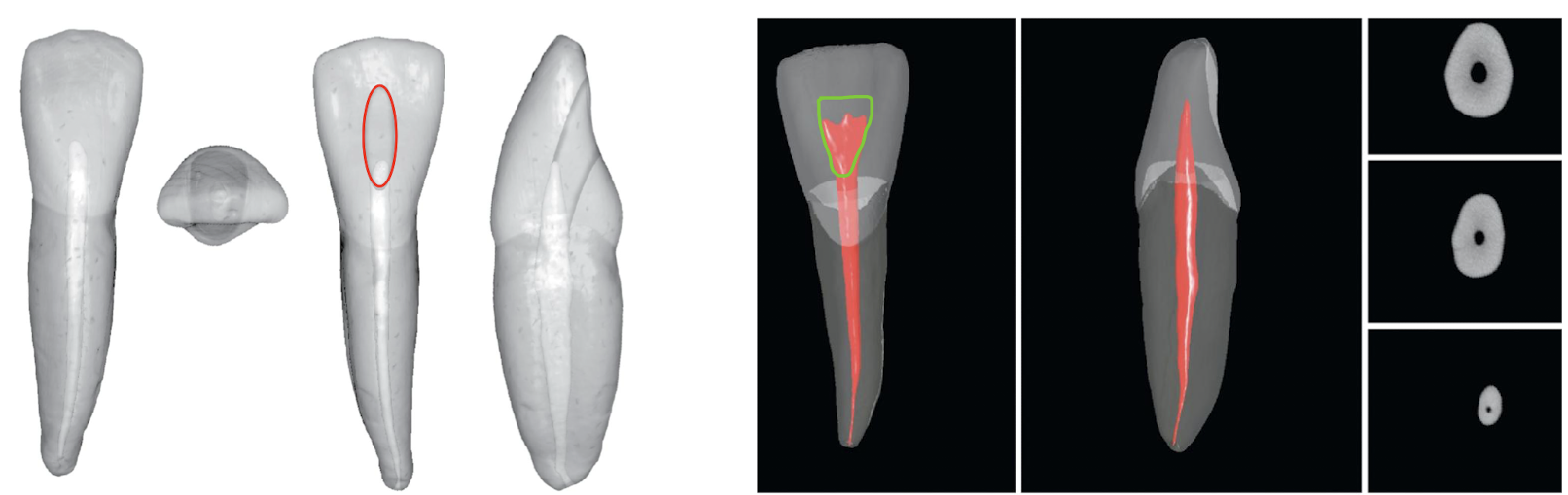 <p>oval or triangle depending on where pulp horns are located </p>