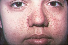 <p>Multiple smooth-surfaced papules most often found on the nose or nasolabial fold in tuberous sclerosis</p>